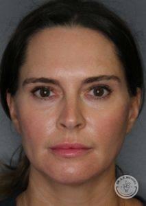 Dr. J. J. Wendel Plastic Surgery after — Nashville, TN