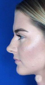 Functional Rhinoplasty before at Dr. J. J. Wendel Plastic Surgery in Nashville, TN