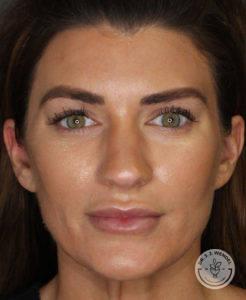 Dr. J. J. Wendel Plastic Surgery after — Nashville, TN