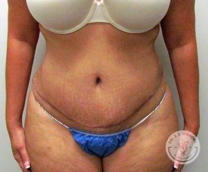Tummy Tuck after at Dr. J. J. Wendel Plastic Surgery in Nashville, TN