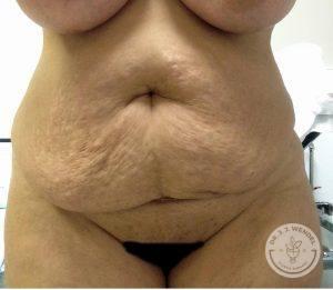 Tummy Tuck before at Dr. J. J. Wendel Plastic Surgery in Nashville, TN