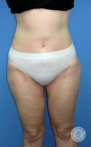 Liposuction after at Dr. J. J. Wendel Plastic Surgery in Nashville, TN