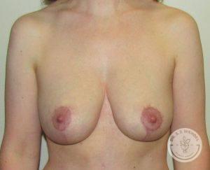 Breast Reduction after at Dr. J. J. Wendel Plastic Surgery in Nashville, TN