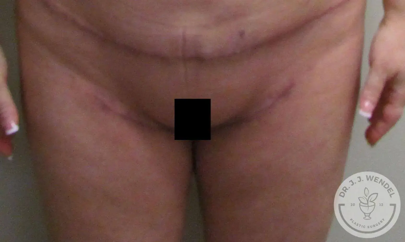 Dr. J. J. Wendel Plastic Surgery thigh lift after — Nashville, TN
