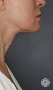 Dr. J. J. Wendel Plastic Surgery after — Nashville, TN