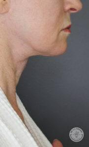 Deep Plane Facelift before at Dr. J. J. Wendel Plastic Surgery in Nashville, TN
