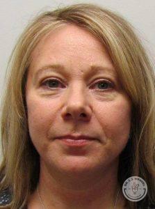 Dr. J. J. Wendel Plastic Surgery facelift after — Nashville, TN