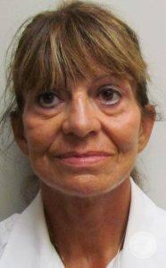 Dr. J. J. Wendel Plastic Surgery facelift after — Nashville, TN