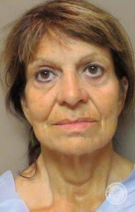 Deep Plane Facelift before at Dr. J. J. Wendel Plastic Surgery in Nashville, TN