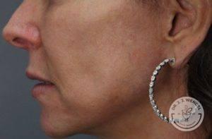 Dr. J. J. Wendel Plastic Surgery after — Nashville, TN
