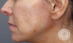 Deep Plane Facelift before at Dr. J. J. Wendel Plastic Surgery in Nashville, TN