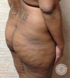 Brazilian Butt Lift before at Dr. J. J. Wendel Plastic Surgery in Nashville, TN