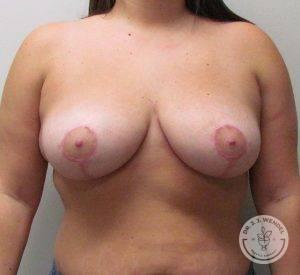 Breast Reduction after at Dr. J. J. Wendel Plastic Surgery in Nashville, TN