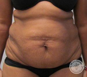 Mini Tummy Tuck before at Dr. J. J. Wendel Plastic Surgery in Nashville, TN