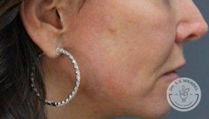 Dr. J. J. Wendel Plastic Surgery after — Nashville, TN