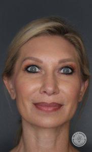 Dr. J. J. Wendel Plastic Surgery after — Nashville, TN