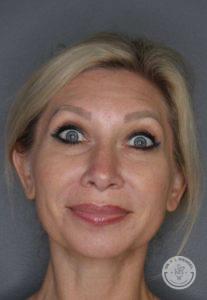 Deep Plane Facelift before at Dr. J. J. Wendel Plastic Surgery in Nashville, TN