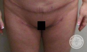 Dr. J. J. Wendel Plastic Surgery thigh lift after — Nashville, TN