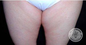 Thigh Lift before at Dr. J. J. Wendel Plastic Surgery in Nashville, TN