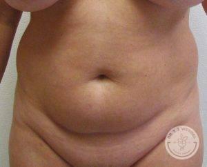 Mini Tummy Tuck before at Dr. J. J. Wendel Plastic Surgery in Nashville, TN