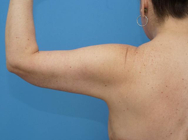 Arm Lift after at Iteld Plastic Surgery in Chicago, IL