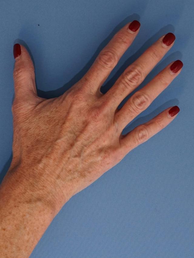 Fat Transfer before at Iteld Plastic Surgery in Chicago, IL