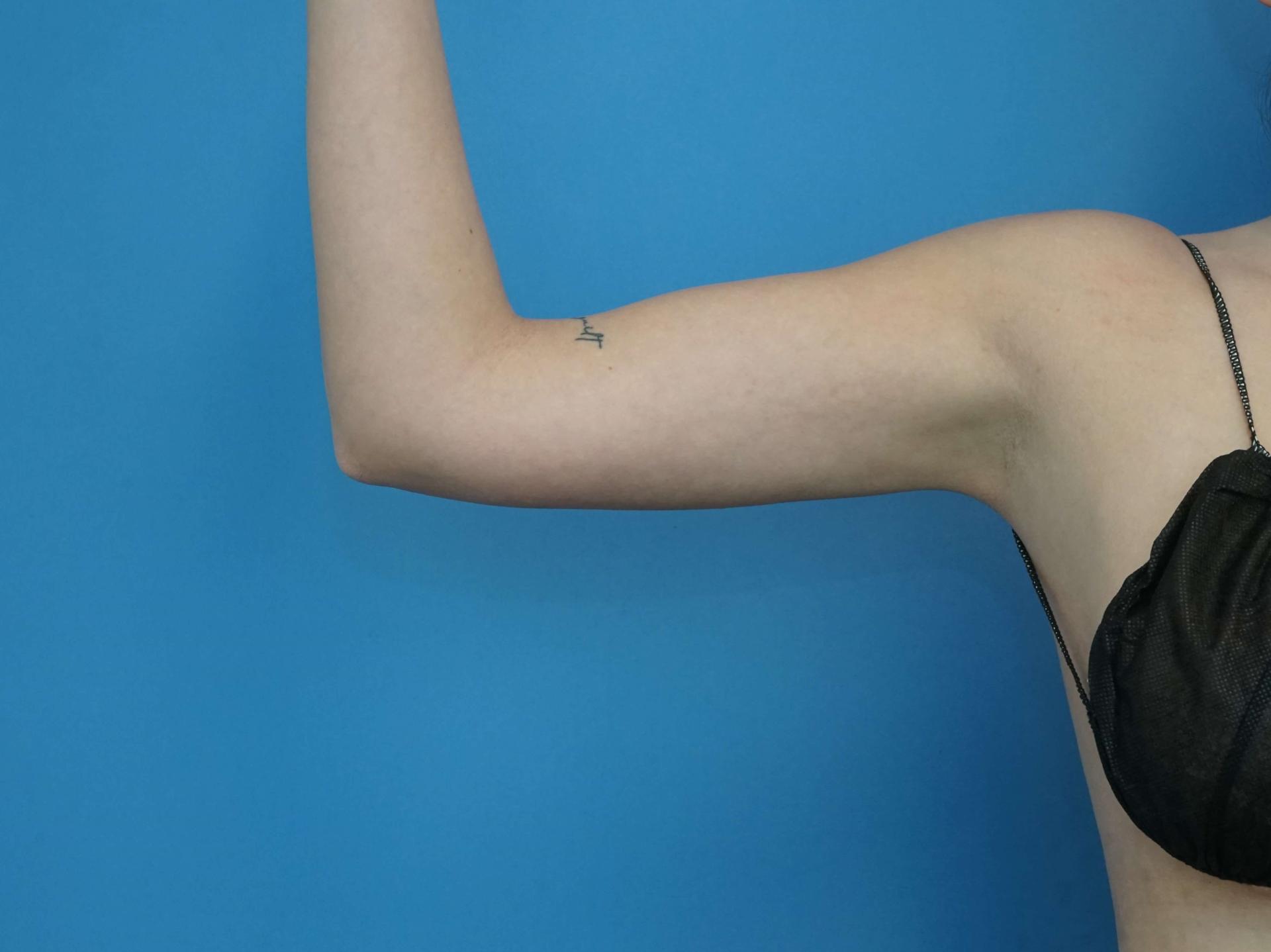 Iteld Plastic Surgery liposuction after — Chicago, IL
