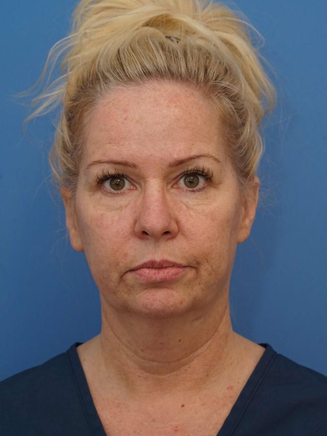 Neck Lift before at Iteld Plastic Surgery in Chicago, IL