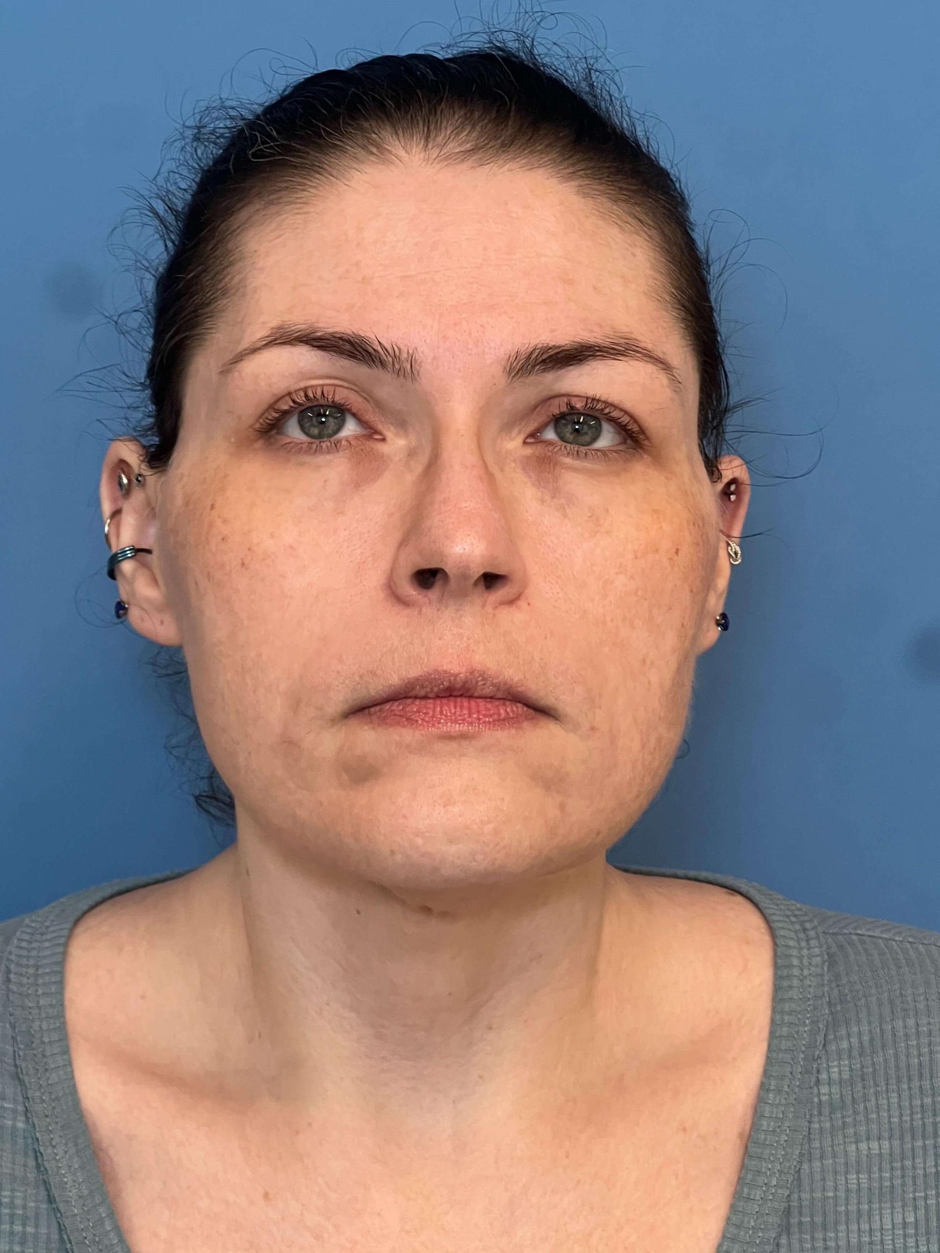 Iteld Plastic Surgery morpheus8 after — Chicago, IL