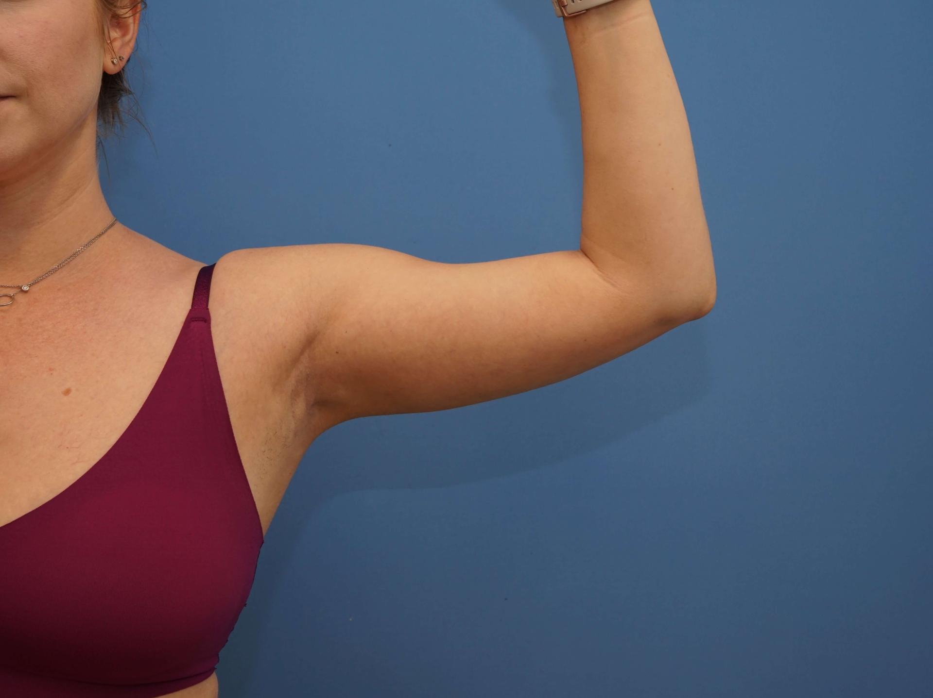 Iteld Plastic Surgery liposuction after — Chicago, IL