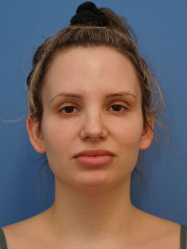 Neck Liposuction before at Iteld Plastic Surgery in Chicago, IL