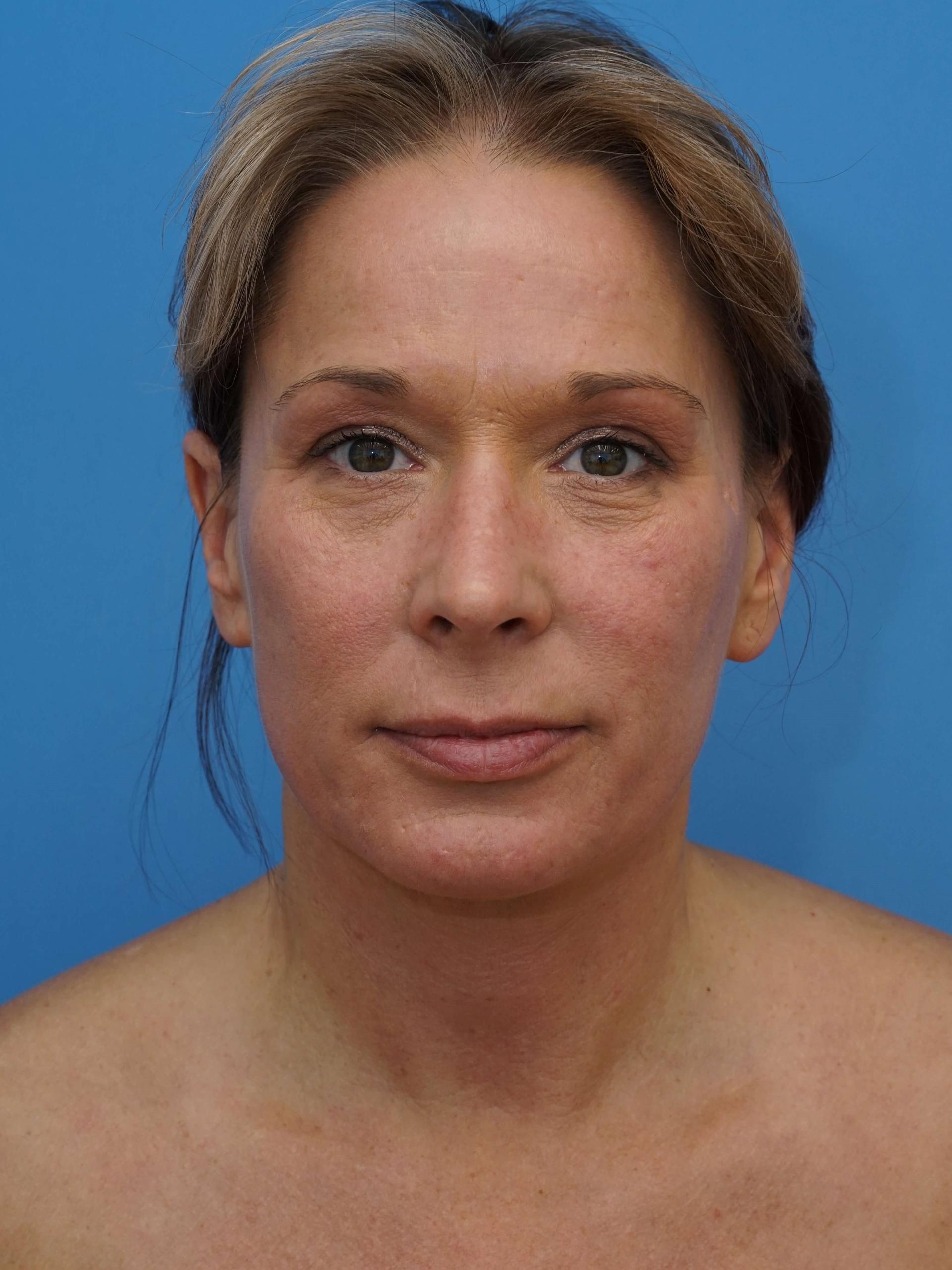 Iteld Plastic Surgery laser treatment after — Chicago, IL
