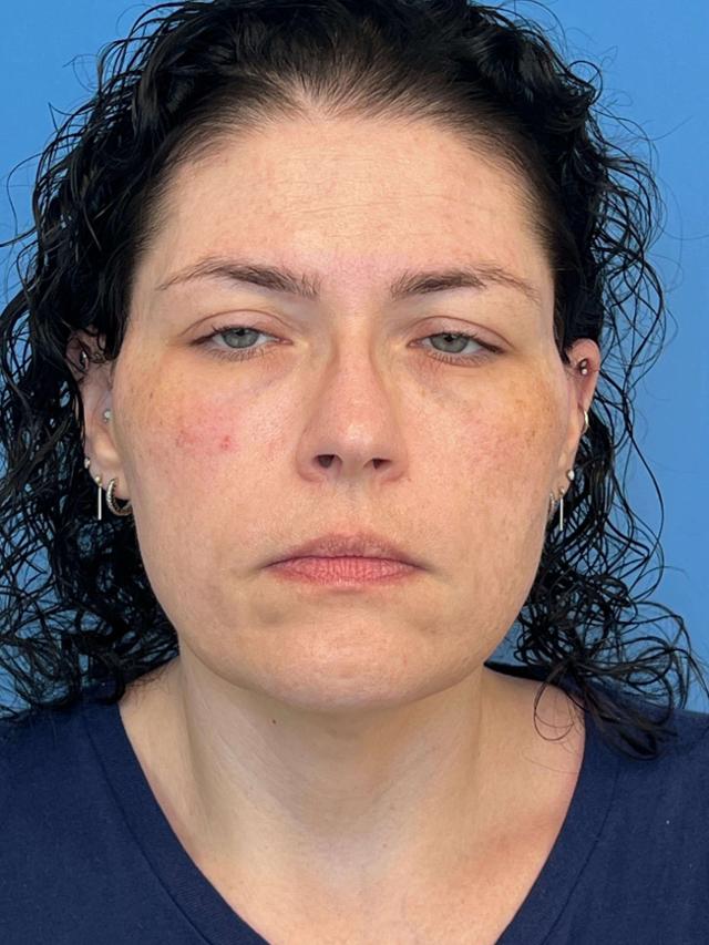 Morpheus8 before at Iteld Plastic Surgery in Chicago, IL