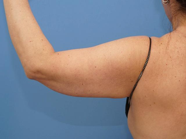 Arm Lift before at Iteld Plastic Surgery in Chicago, IL