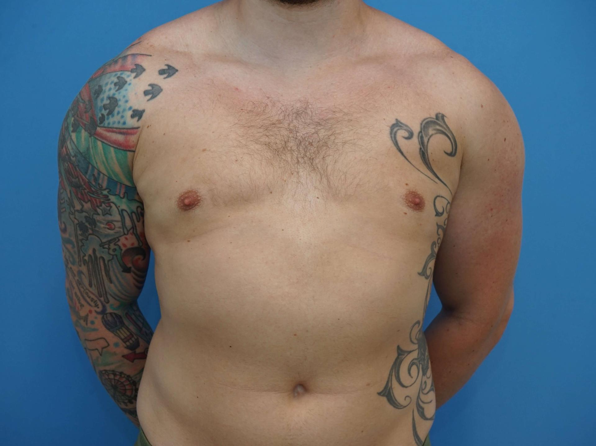 Iteld Plastic Surgery liposuction after — Chicago, IL