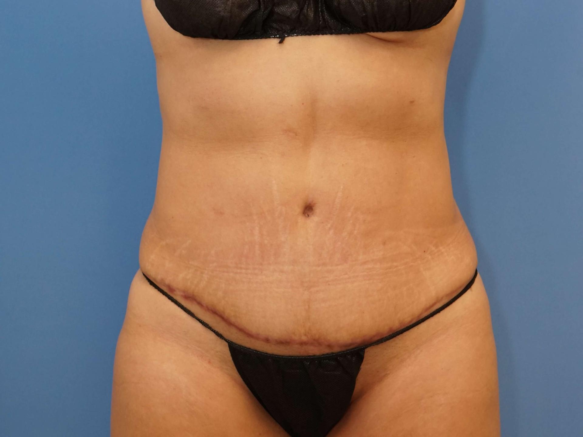 Iteld Plastic Surgery tummy tuck after — Chicago, IL