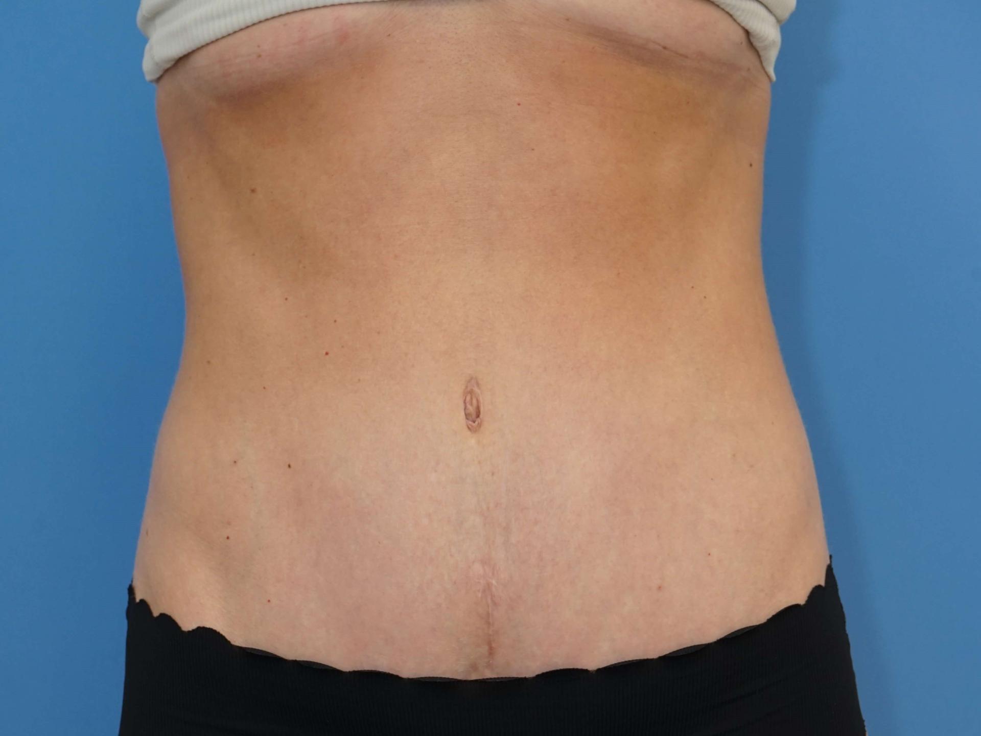 Iteld Plastic Surgery tummy tuck after — Chicago, IL