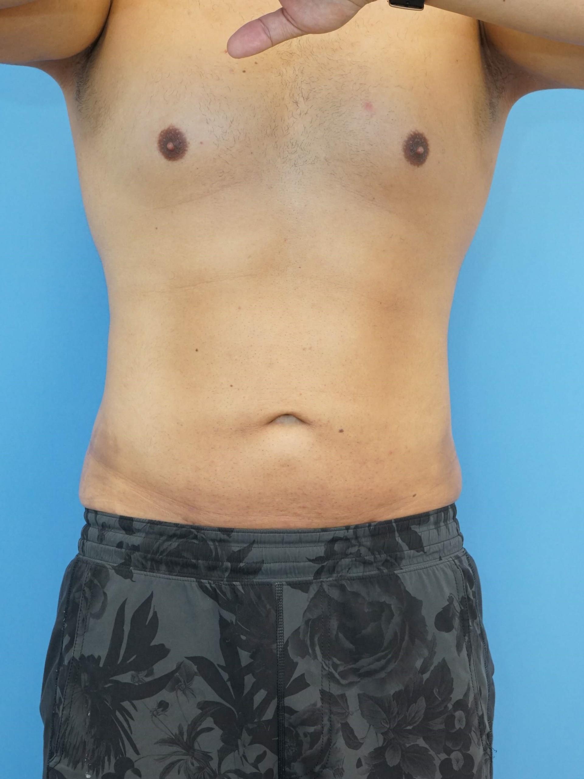 Iteld Plastic Surgery liposuction after — Chicago, IL