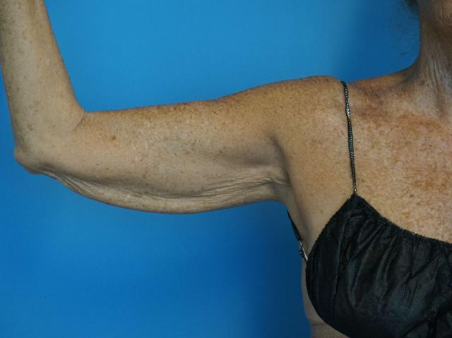 Arm Lift before at Iteld Plastic Surgery in Chicago, IL