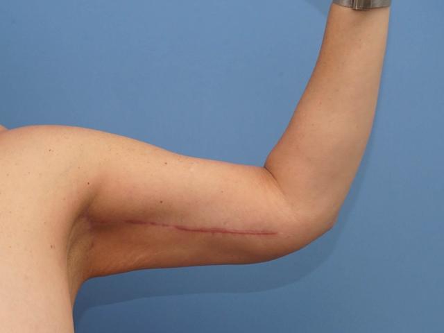 Arm Lift after at Iteld Plastic Surgery in Chicago, IL