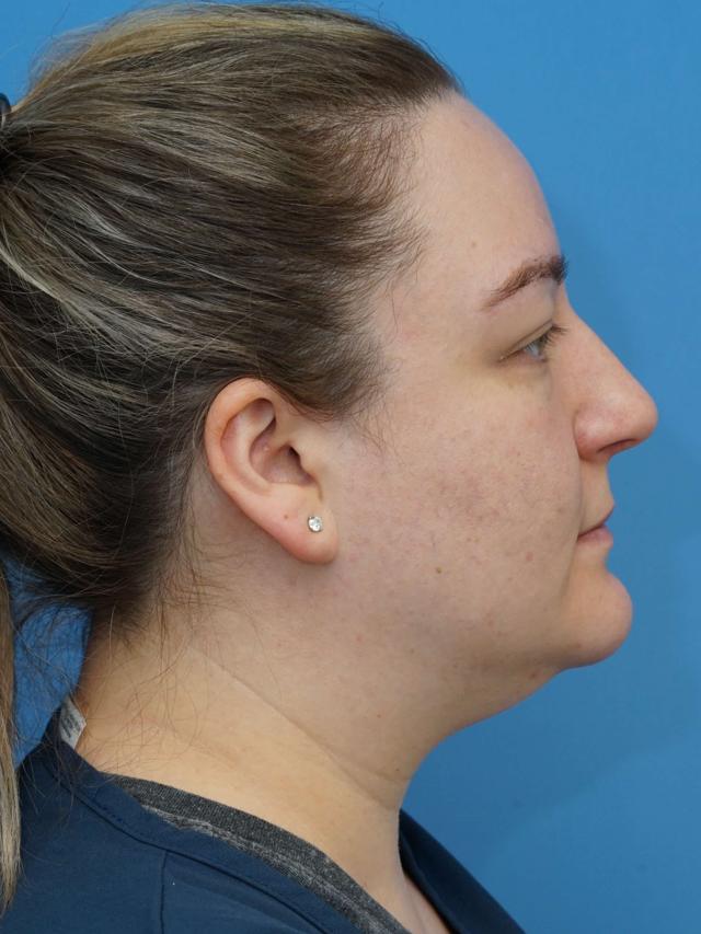 Neck Liposuction before at Iteld Plastic Surgery in Chicago, IL