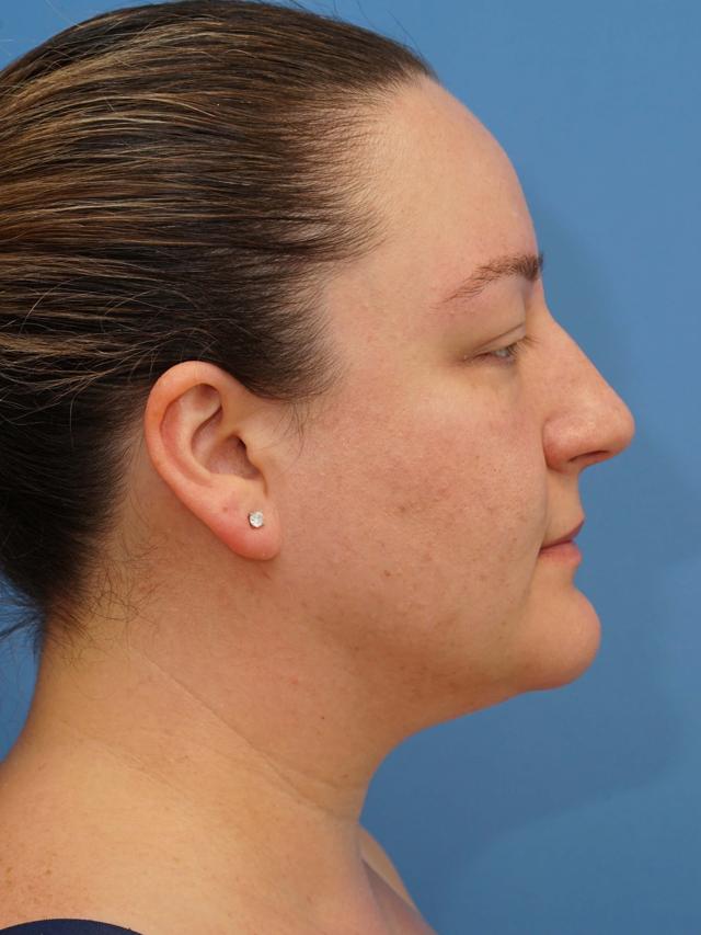 Neck Liposuction after at Iteld Plastic Surgery in Chicago, IL