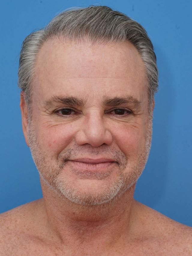 Neck Lift before at Iteld Plastic Surgery in Chicago, IL