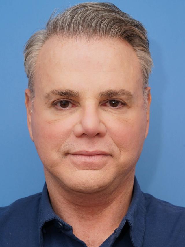 Neck Lift after at Iteld Plastic Surgery in Chicago, IL