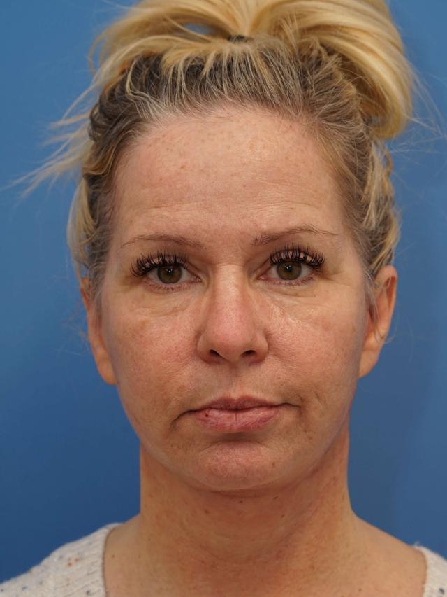 Neck Lift after at Iteld Plastic Surgery in Chicago, IL