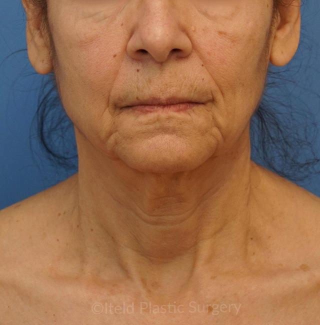 Neck Lift before at Iteld Plastic Surgery in Chicago, IL
