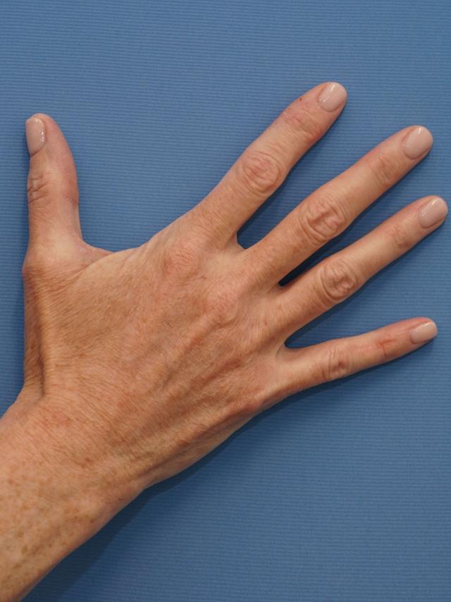 Fat Transfer after at Iteld Plastic Surgery in Chicago, IL