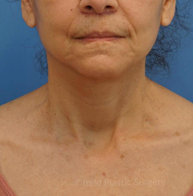 Neck Lift after at Iteld Plastic Surgery in Chicago, IL