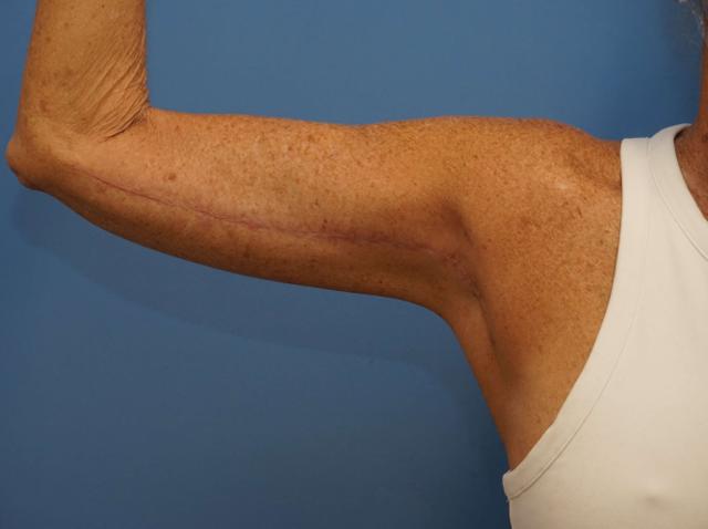 Arm Lift after at Iteld Plastic Surgery in Chicago, IL