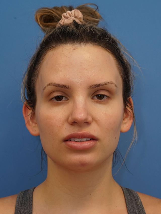 Neck Liposuction after at Iteld Plastic Surgery in Chicago, IL